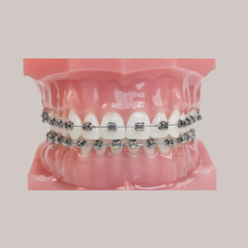 Vaste Beugel orthodontie voorbeeld Ortho Noord