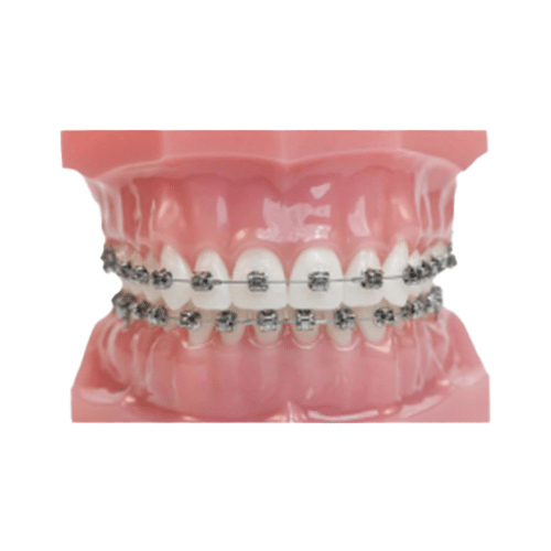 Vaste Beugel orthodontie voorbeeld Ortho Noord Veendam, Assen en Stadskanaal